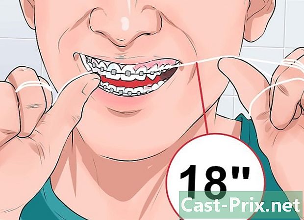 歯科用リングをきれいにする方法