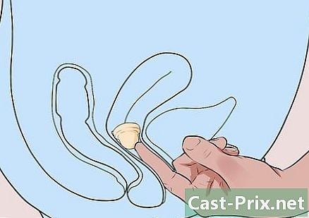 Hur man placerar en cervical mössa
