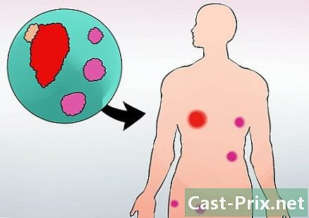 Com reconèixer els símptomes del càncer de pròstata - Guies
