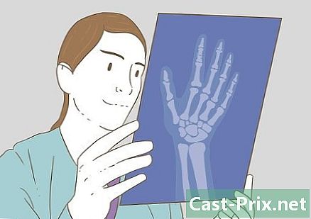 Làm thế nào để biết một ngón tay bị hỏng - HướNg DẫN