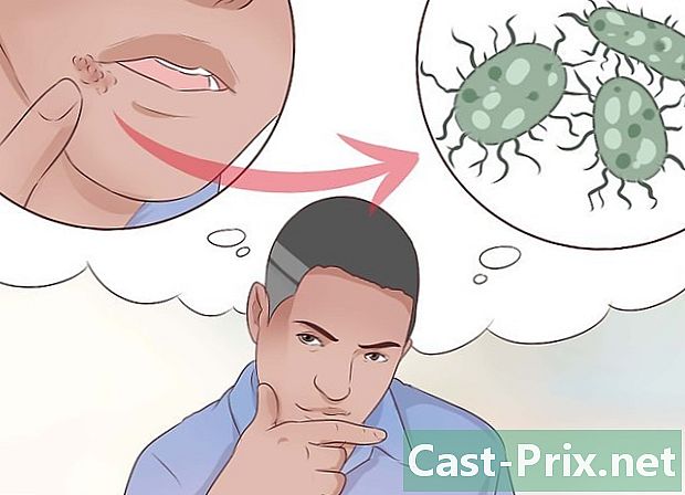 Cómo saber si tienes herpes labial - Guías
