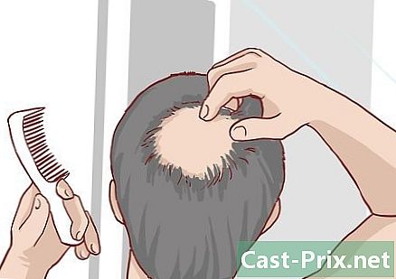 男性型脱毛症の有無を確認する方法