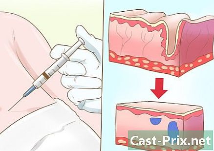 Como se livrar de cicatrizes de acne no peito