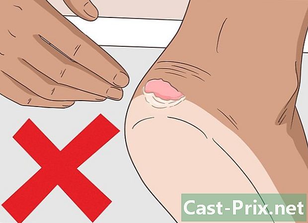 Come curare un bulbo del piede