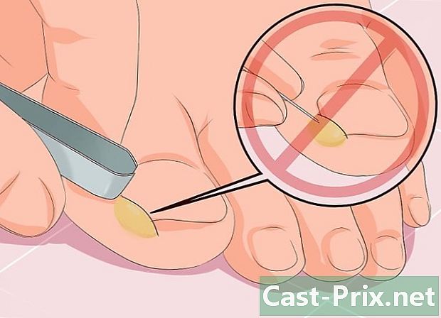 Com tractar una infecció amb les ungles de la punta del peu incrustades