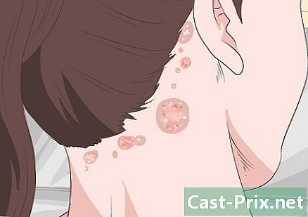 Come trattare l'eczema del cuoio capelluto - Guide