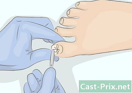 Como tratar a litólise - Guias