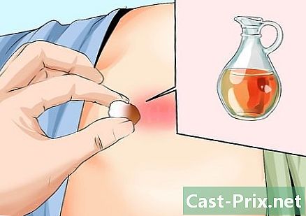 Jak léčit pilonidální cystu - Vodítka