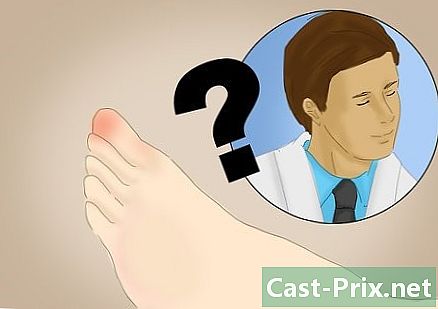 Jak leczyć obolały palec u nogi