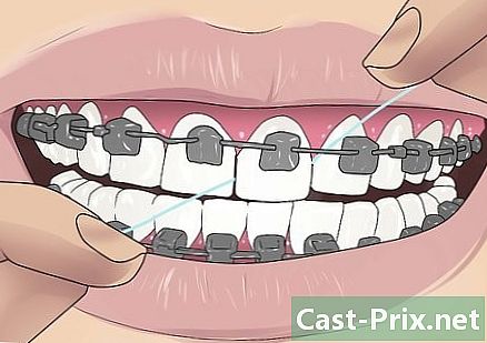Hur man använder tandtråd när man bär en enhet - Guider